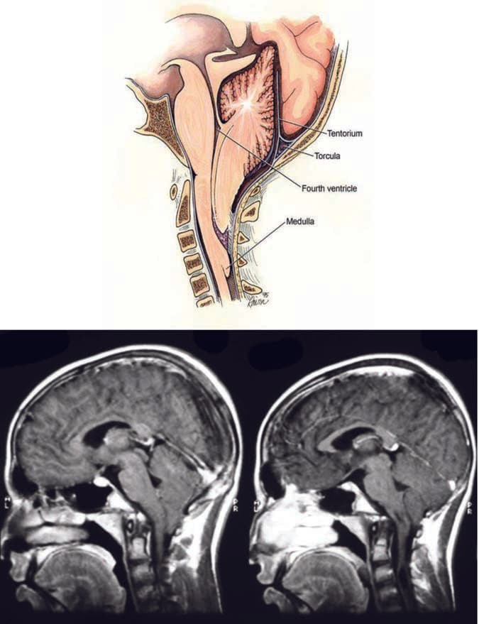 Arnold-Chiari Malformasyonu — resim 3