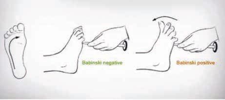 Babinski Bulgusu — resim 2