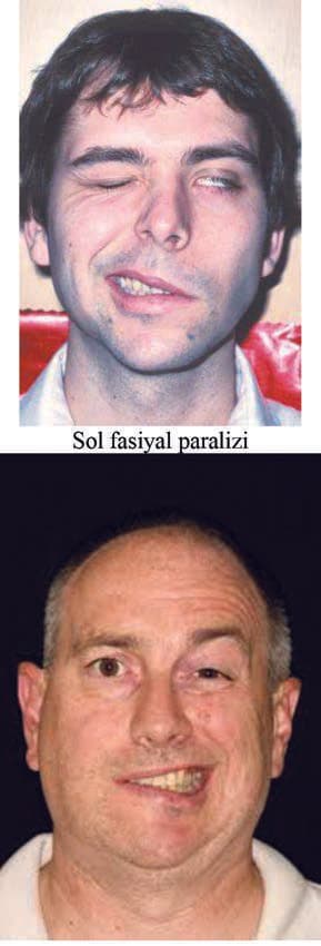 Bell Paralizisi — resim 2