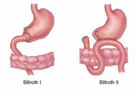 Billroth Ameliyatları — resim 2