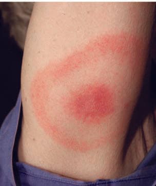 Borrelia Burgdorferi — resim 5