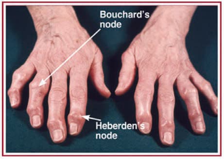 Bouchard Nodülleri — resim 2
