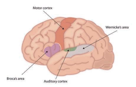 Broca Afazisi — resim 3