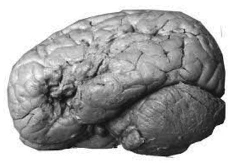 Broca Afazisi — resim 4