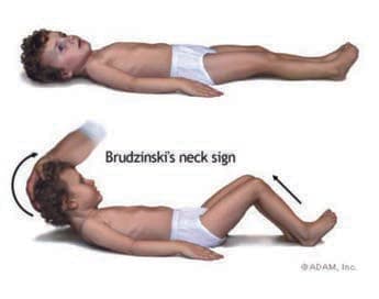 Brudzinski Belirtisi — resim 2