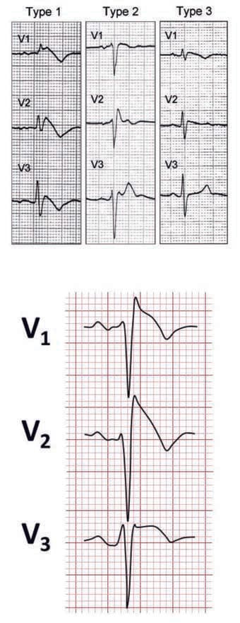 Brugada Sendromu — resim 3