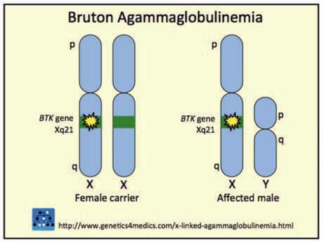 Bruton Agammaglobulinemisi — resim 2