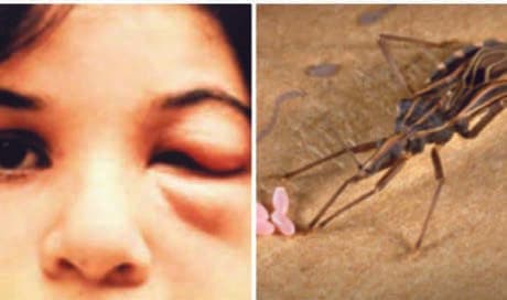 Chagas Hastalığı — resim 3