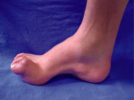 Charcot-Marie-Tooth Hastalığı — resim 3