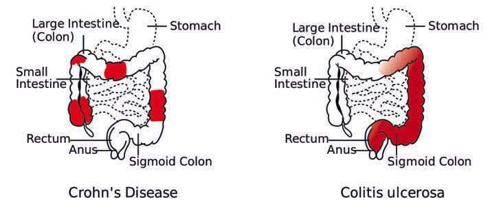 Crohn Hastalığı — resim 2