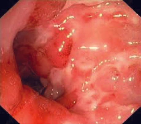Crohn Hastalığı — resim 3