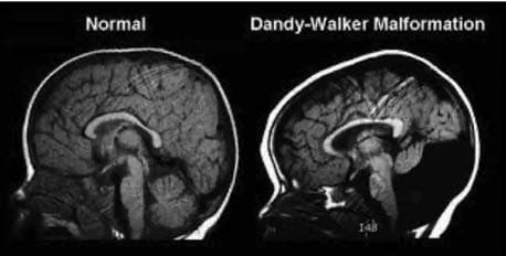 Dandy-Walker Sendromu — resim 4