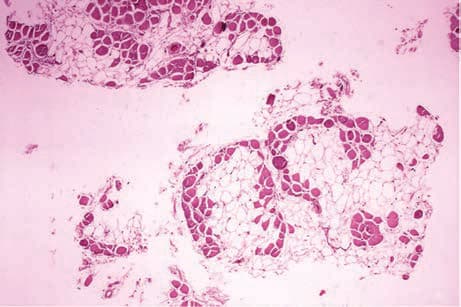 Duchenne Müsküler Distrofisi — resim 4