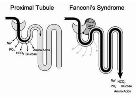 Fanconi Sendromu — resim 2