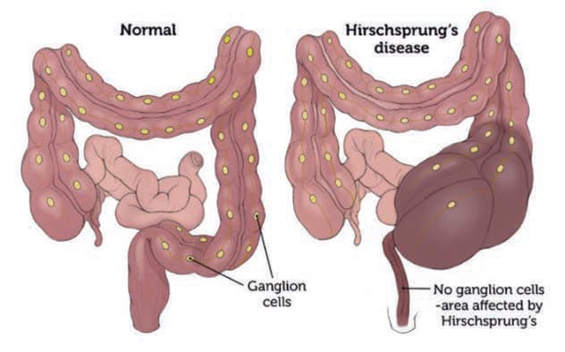 Hirschsprung Hastalığı — resim 2