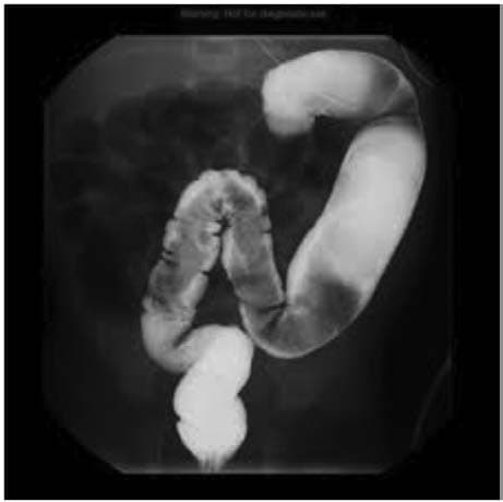 Hirschsprung Hastalığı — resim 3