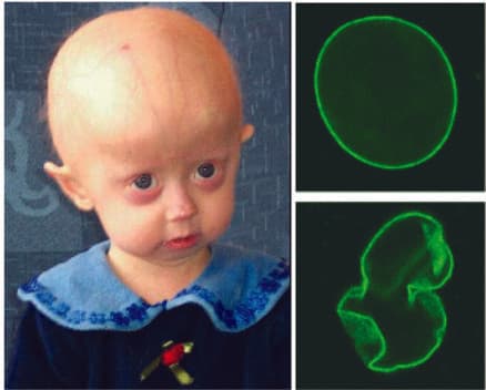 Hutchinson-Gilford Progeria Sendromu — resim 3