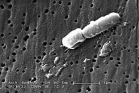 Klebsiella Pnömonisi — resim 2