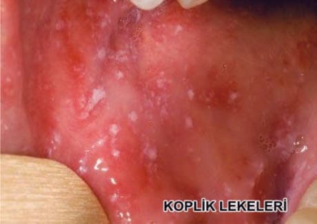 Koplik Lekeleri — resim 2