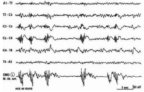 Kozhevnikov Epilepsisi — resim 2