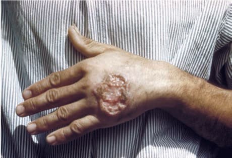 Leishmania Donovani — resim 4