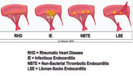 Libman-Sacks Endokarditi — resim 5