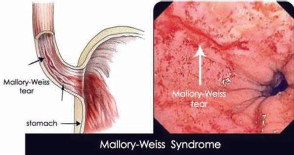 Mallory-Weiss Sendromu — resim 3