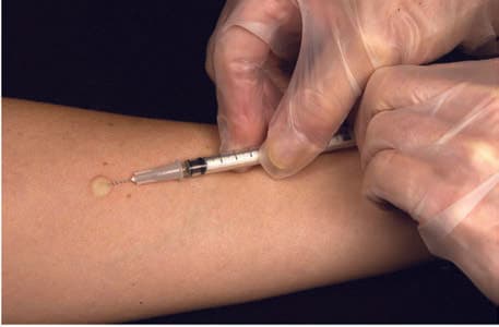 Mantoux Testi — resim 2