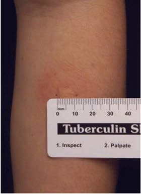 Mantoux Testi — resim 3