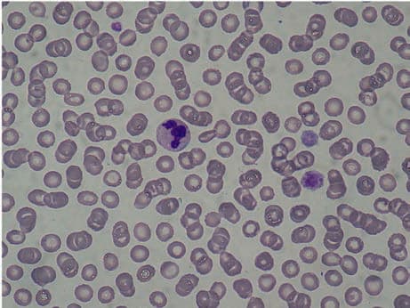 May-Hegglin Anomalisi — resim 2