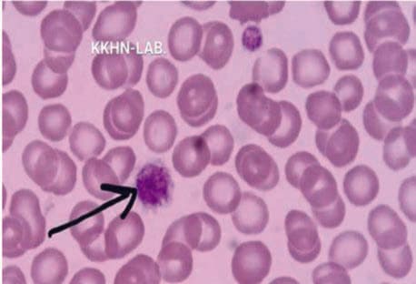 May-Hegglin Anomalisi — resim 3