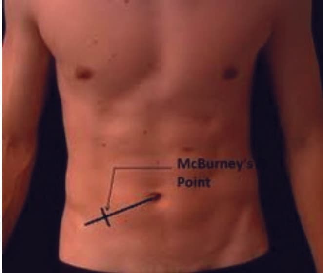 McBurney Noktası — resim 2