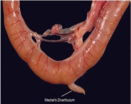 Meckel Divertikülü — resim 3