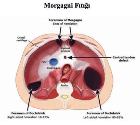 Morgagni Fıtığı — resim 2