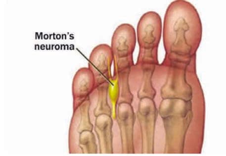 Morton Nöroma — resim 2