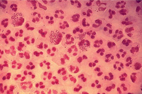 Neisseria Gonorrhea — resim 3