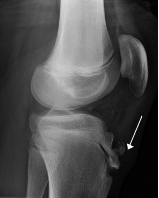 Osgood-Schlatter Hastalığı — resim 3