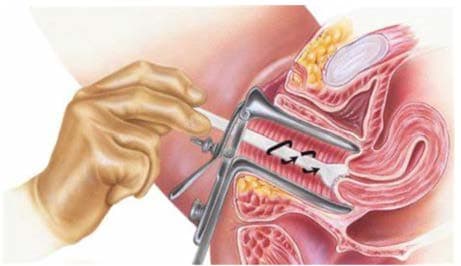 Pap Smear — resim 2