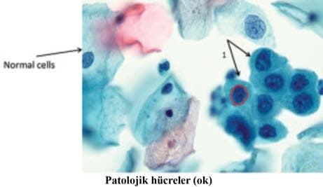 Pap Smear — resim 3