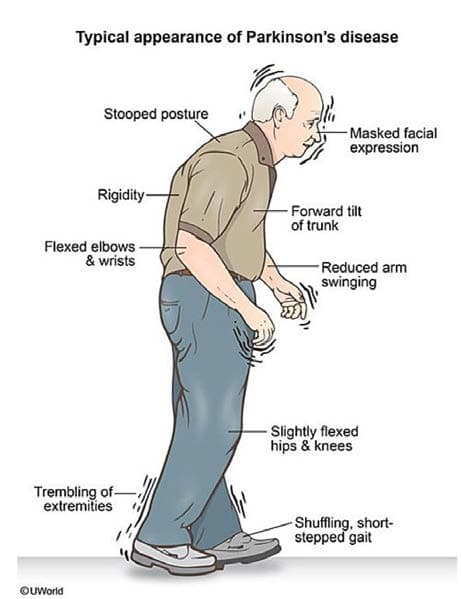 Parkinson Hastalığı — resim 2