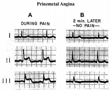 Prinzmetal Angina — resim 2