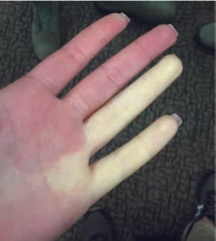 Raynaud Sendromu — resim 2