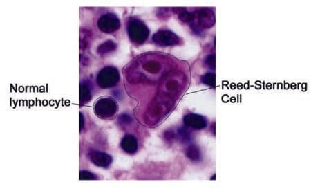Reed-Sternberg Hücresi — resim 4