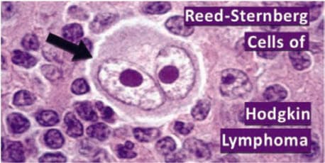 Reed-Sternberg Hücresi — resim 5