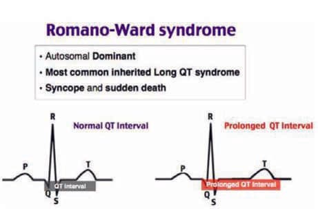 Romano-Ward Sendromu — resim 3