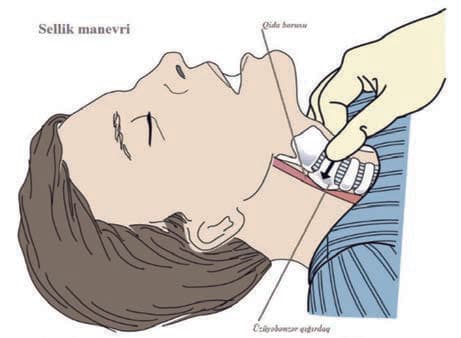 Sellick Manevrası — resim 1