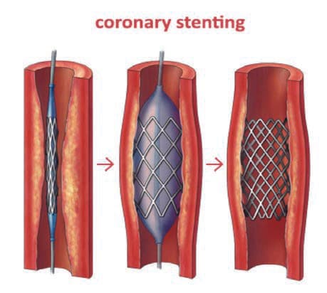 Stent — resim 3