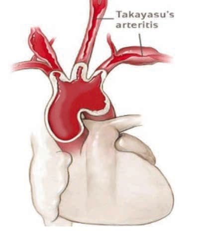 Takayasu Arteriti — resim 2