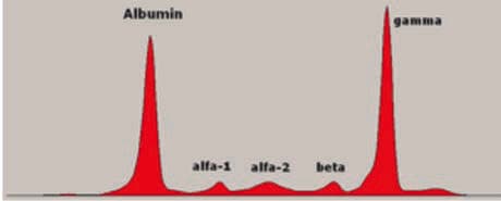 Waldenström Makroglobulinemisi — resim 3