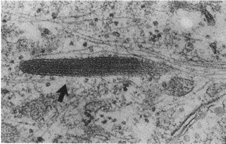 Weibel-Palade Cisimleri — resim 4